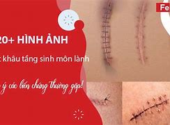 Khâu Tầng Sinh Môn Tiếng Anh